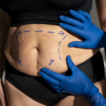 fibrosis abdominal post lipoescultura