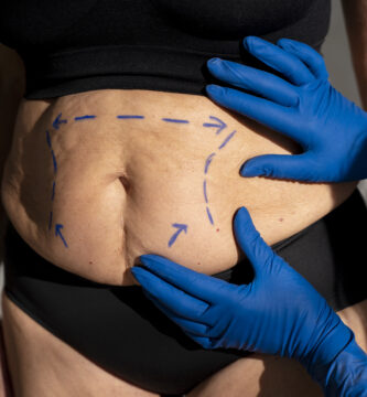 fibrosis abdominal post lipoescultura