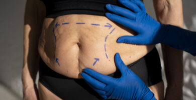 fibrosis abdominal post lipoescultura